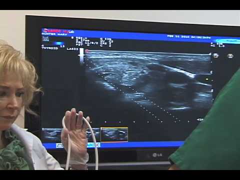 how to perform lymph node biopsy