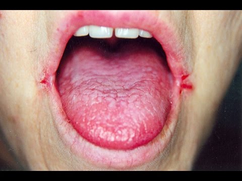 how to cure angular cheilitis