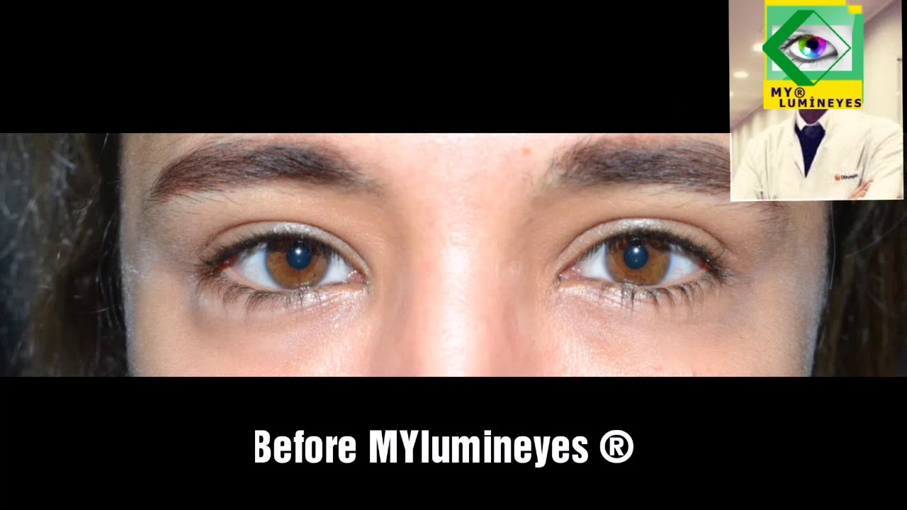 Procedimento de cirurgia de mudança de cor dos olhos a laser marrom a olhos azuis incríveis!