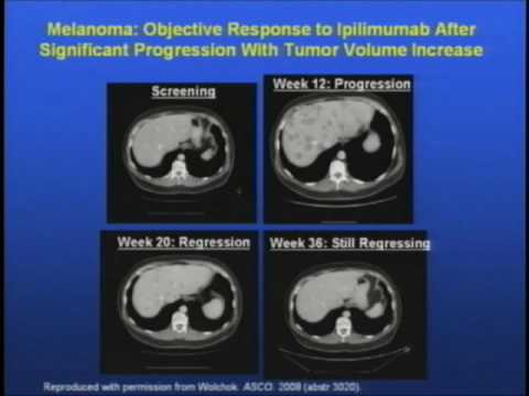 Taking Aim at Melanoma: Targeted Therapy and Immunotherapy