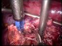 European Urology - Surgery In Motion - November 2007 video (1) European Urology - Surgery In Motion - November 2007 video (1)