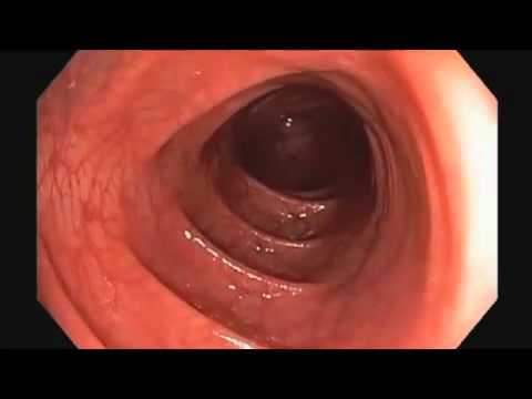 Colonoscopy Video Tour: Journey Through a Healthy Colon