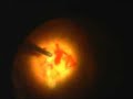 Diabetic Retinal Detachment