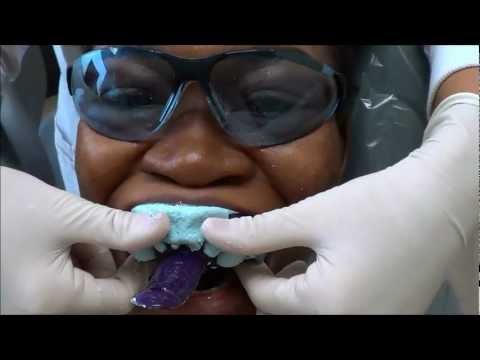 how to make retainers fit again