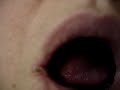 Oral Herpes Simplex ... Cold Sore #01  Cold Sore Herpes Simplex