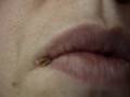 herpes chap lips