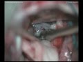 Clival chordoma - Left retrosigmoid approach