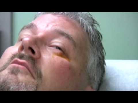 Chalazion Injection Demonstration