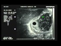 Stomach - Linitis Plastica Stomach - Linitis Plastica
