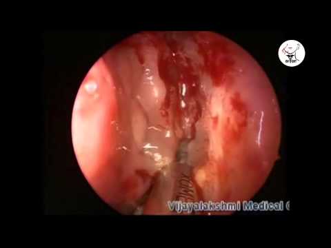 how to treat chronic sinusitis