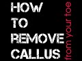 How to remove the callus from your toe.