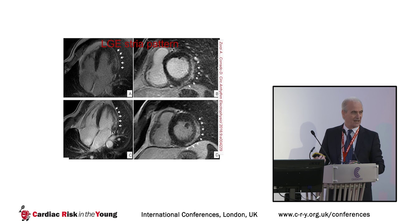 Myocardial Fibrosis in Athletes - Dr Domenico Corrado