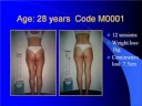 Endermologie Results Presented by Transfit Endermologie Results Presented by Transfit