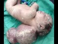 Encephalocele