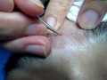 pimple picking 4