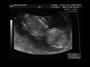 macarena 5 29 cm 11 semanas 4 dias