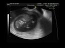 macarena 5 29 cm 11 semanas 4 dias