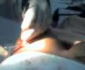 Reparo de uma cirurgia de Protese de silicone.. Reparo de uma cirurgia de Protese de silicone..