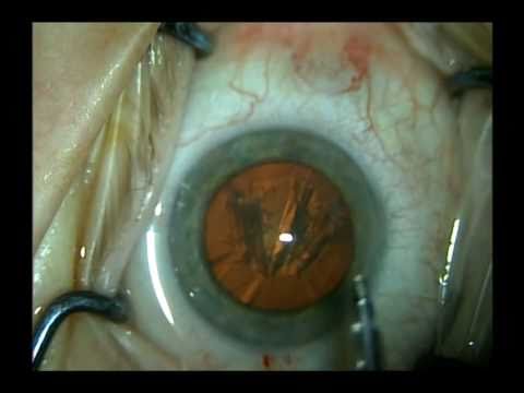 Routine cataract surgery
