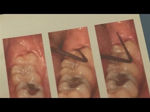 how to relieve growing wisdom teeth pain
