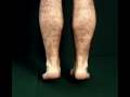 Gastrocnemius