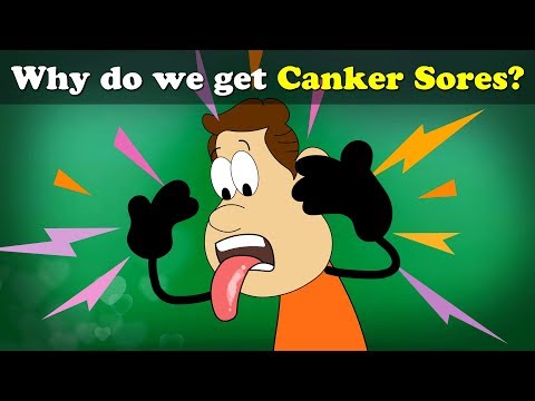 Why Do We Get Canker Sores? Thumbnail