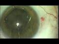videos de Boris Malyugin's, Russian Solution to small pupil phaco and