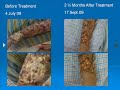 Ayusanjivani ChikitsaRay of Hope In Management of Cancer - Malignant Melanoma Case Study