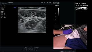 How to Perform an Ultrasound-Guided Fascia Iliaca Plane Block