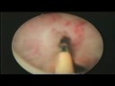 Optical Urethrotomy Optical Urethrotomy