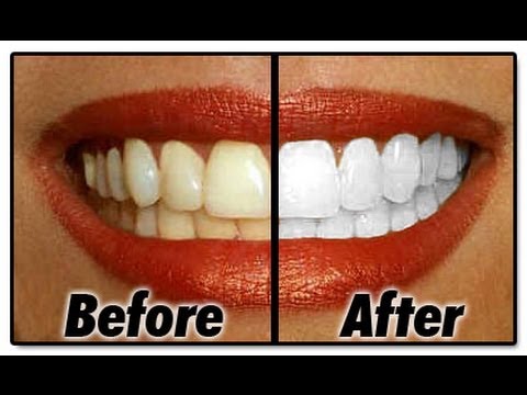 how to whiten your teeth in a day