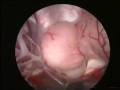 Sampling The Tumor Of Hypothalamus With The Endoscope Sampling The Tumor Of Hypothalamus With The Endoscope