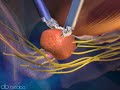 Da Vinci Robot. Prostatectomia Da Vinci Robot. Prostatectomia