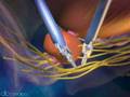 Da Vinci Robot. Prostatectomia