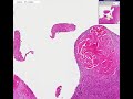 Histopathology Elbow--Chronic fibrinous bursitis Histopathology Elbow--Chronic fibrinous bursitis