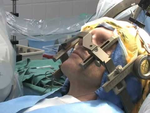 DBS - Mayfield Clinic provides a step by step walk thru of a Deep Brain Stimulation (DBS) procedure for the treatment of Parkinson's disease and essential tremor. ...