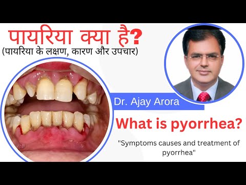 What is Pyorrhea, Causes, Symptoms and Treatment?