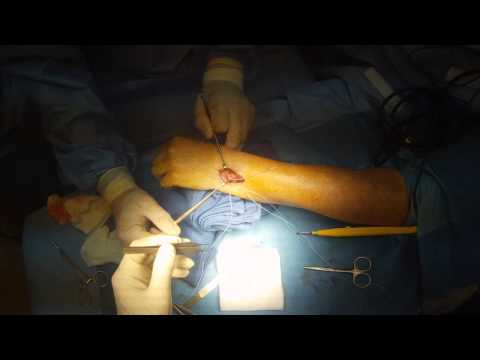 how to repair tfcc tear
