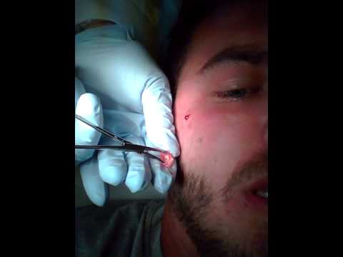 how to drain cyst