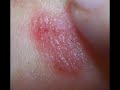Important shocking news, new disease Morgellons, it\ Important shocking news, new disease Morgellons, it\