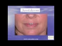 Lip rejuvenation with Juvederm- Min S. Ahn, MD, FACS