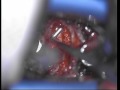 Anterior Cervical Discectomy and Fusion with Allograft