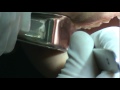 Removal of Orthodontic Anchor in Buccal Shelf (right side)