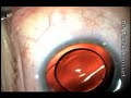 Refractive Clear Lens Extraction with Limbal Relaxing Incisi Refractive Clear Lens Extraction with Limbal Relaxing Incisi