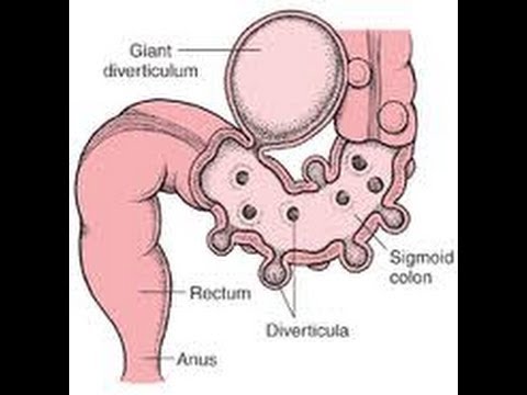 how to relieve diverticulitis