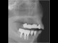 DVT neue 3D Tomographie mit 90% weniger Strahlenbelastung