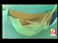 Lipo Laser - Laser fat reduction