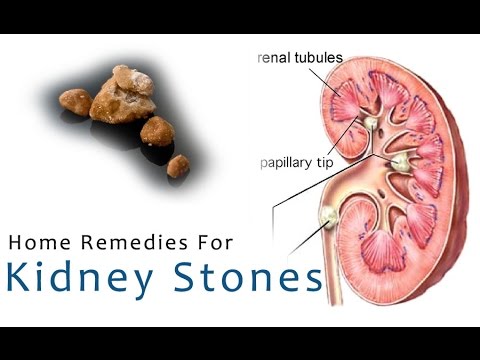 how to dissolve 20 mm kidney stones