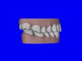 Patien # 1125078 Right Buccal