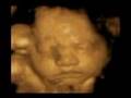 This is our little Abigail at 31 weeks old 4d